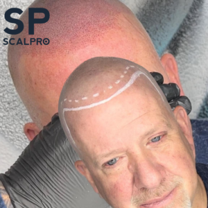 SMP Procedure