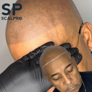Scar SMP Procedure