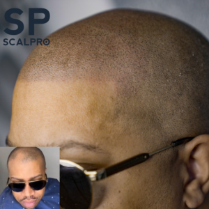 Full SMP Procedure